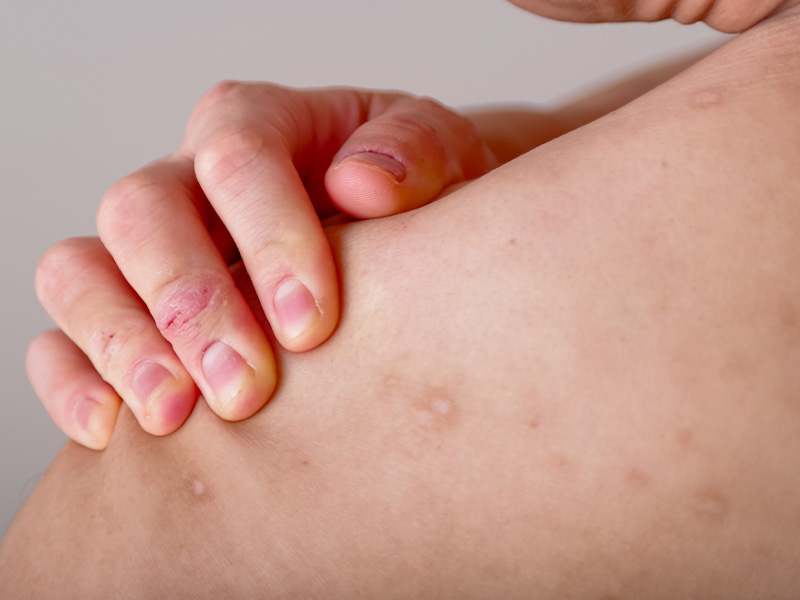 アトピー性皮膚炎の治療